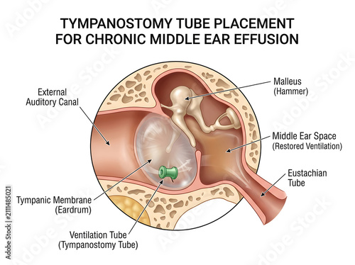 Tympanostomy tube placement in human ear diagram illustration isolated on white background