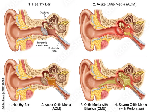 Ear conditions comparison illustration with healthy and diseased states isolated on white background
