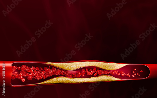 Bild auf Leinwand Artery blockage caused by cholesterol accumulation reducing blood flow and oxygen delivery illustrating advanced atherosclerosis and elevated cardiovascular disease risk