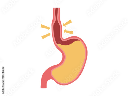 Foto Scleroderma Disease in Stomach