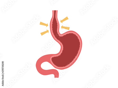Bild auf Leinwand Scleroderma Disease in Stomach