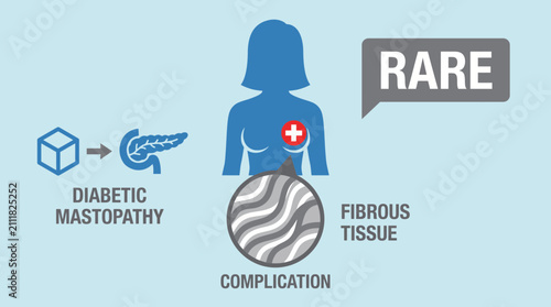 Fotografie Diabetic Mastopathy Breast Fibrous Tissue Complication Rare