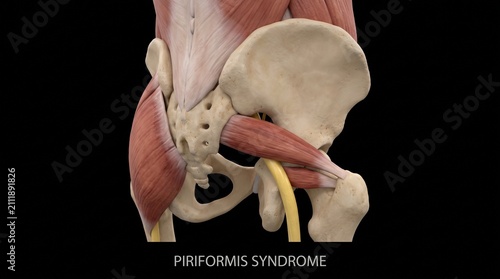 Human Piriformis Syndrome Sciatic Nerve Entrapment Model