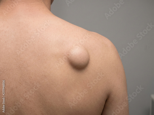 Upper back skin with lipoma showing soft round subcutaneous lump under skin, benign fatty tumor dermatology medical concept