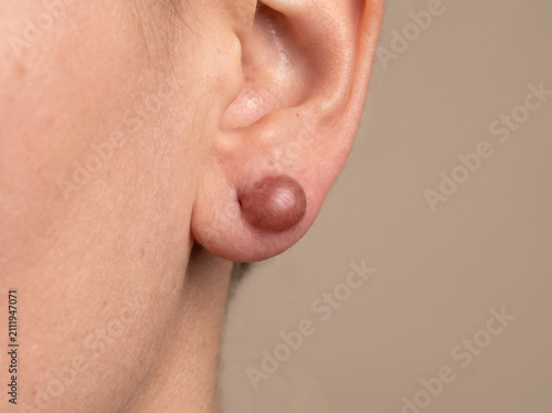 Earlobe with keloid scar showing raised smooth overgrown scar tissue from piercing, abnormal scarring dermatology medical concept