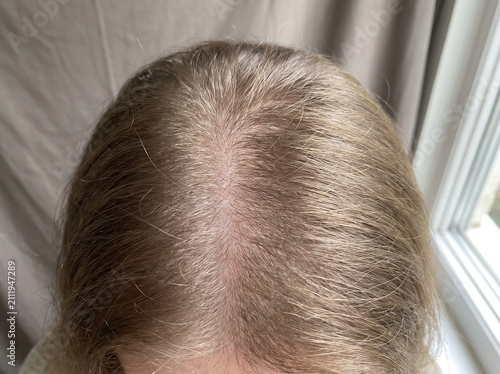 Scalp crown showing diffuse hair thinning from telogen effluvium, temporary hair loss condition trichology medical concept