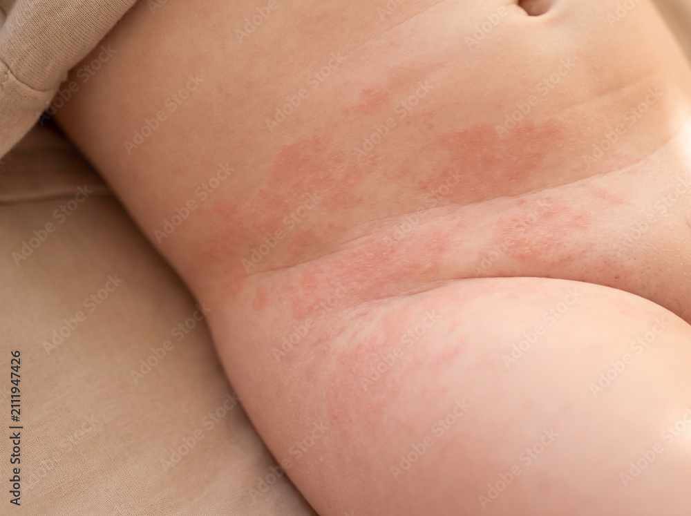 Fototapeta premium Infant skin with mild diaper rash showing pink red irritated patches, common pediatric skin condition dermatology parenting concept