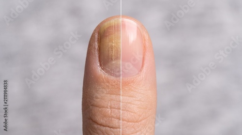 Before and after yellow stained nail to healthy pink fingernail	