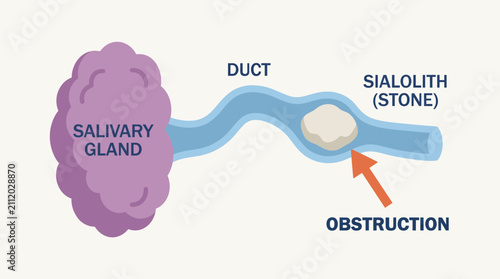 Fotografie Sialolithiasis Salivary Stone Formation Obstruction