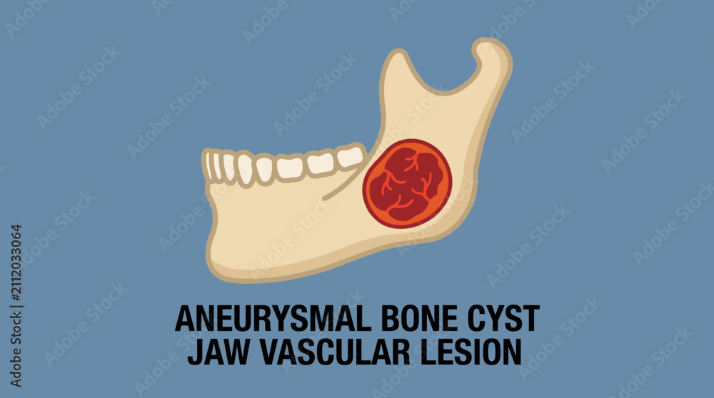Fototapeta premium Aneurysmal Bone Cyst Jaw Vascular Lesion