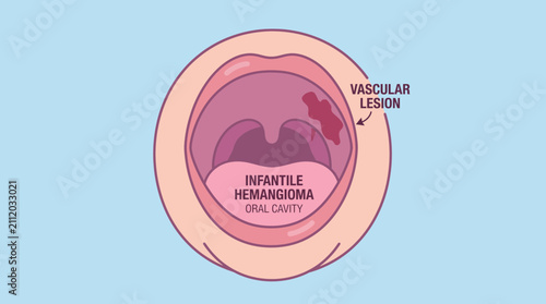 Fotografie Infantile Hemangioma Oral Cavity Vascular Lesion