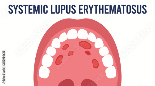 Obraz na plátne Systemic Lupus Erythematosus Oral Ulceration Palatal