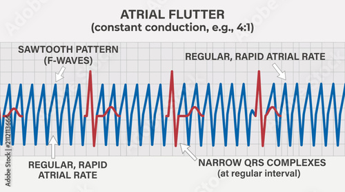 Tableau sur toile Atrial Flutter Regular Rapid Atrial Rate Saw Tooth Pattern