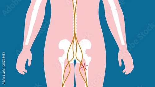 A sciatic pinched nerve shooting pain radiating from the lower back through the leg medical anatomy illustration