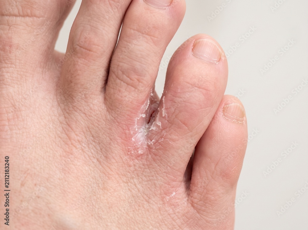 Fototapeta premium Athlete’s Foot Tinea Pedis Fungal Infection Between Toes Close Up Dermatology