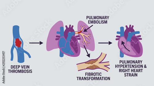 Foto Chronic Thromboembolic Pulmonary Hypertension CTEPH Pathophysiology