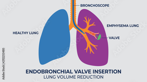 Foto Endobronchial Valve Insertion for Emphysema Lung Volume Reduction