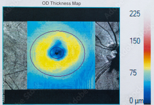 Obraz na plátne An Optical Coherence Tomography (OCT) scan of the human retina, specifically cap
