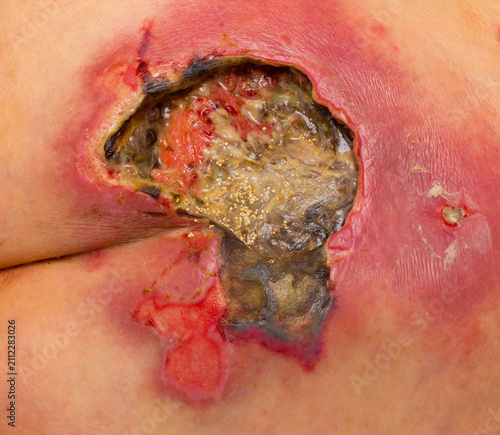 Cuadro en lienzo Pressure ulcer in the sacral (coccyx) region with necrotic tissue, slough and granulation tissue