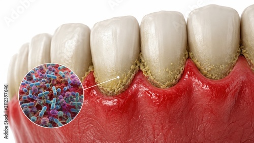 3D dental visualization of plaque bacteria and gum inflammation