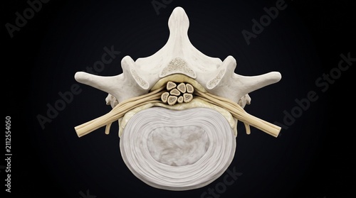 Cross Section Sciatic Nerve Entrapment Intervertebral Foramen Model