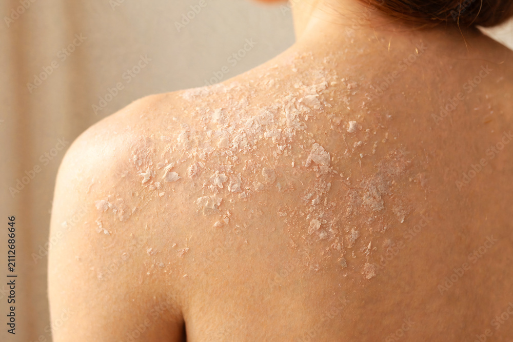 Fototapeta premium Close Up of Dry Flaky Skin on Woman Back