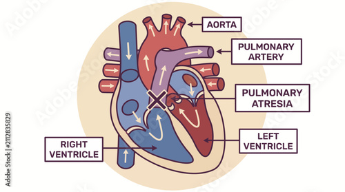 Bild auf Leinwand Pulmonary Atresia Congenital Absence of Right Ventricular Outflow