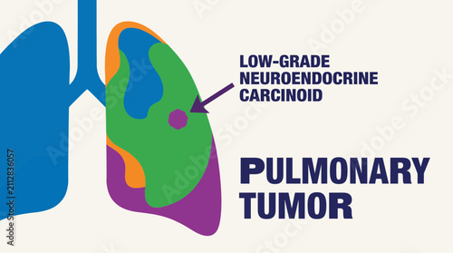 Canvastavla Pulmonary Tumor Carcinoid Neuroendocrine Low-Grade Malignancy