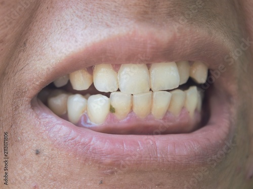 Fotografía A close-up view of a person's mouth showing crooked, yellowish teeth with visibl