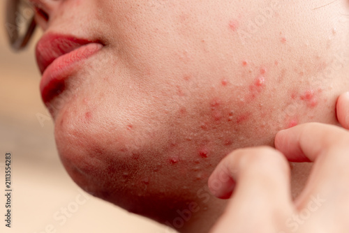 Quadro su tela Close up of woman cheek with problematic skin conditions including acne, pimples, red spots and blemishes