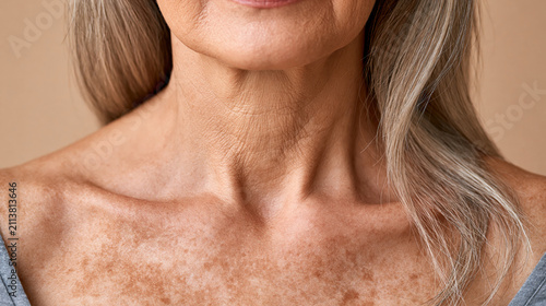 Mature senior woman showing deep wrinkles on her neck and hyperpigmentation on her decolletage, the sun damaged skin displaying numerous age spots and freckles