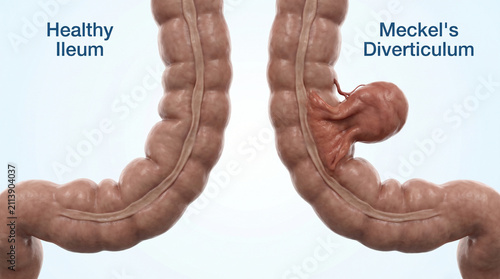 Healthy Ileum and Meckel's Diverticulum Intestinal Anatomy