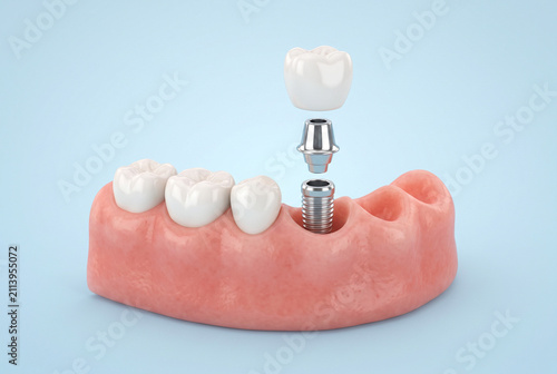 Dental Implant Model with Gum Tissue and Ceramic Crown for Oral Restoration Education