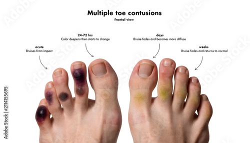 Frontal view of foot showing multiple toe contusion healing stages, medical stock photo on white background