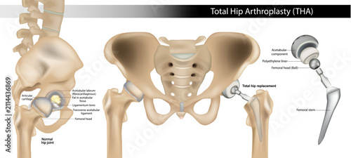 Total Hip Arthroplasty (THA) with Prosthetic Components and Normal Hip Joint Anatomy. Total Hip Replacement Surgery with Implant Components and Normal Hip Joint Anatomy