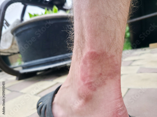 Bild auf Leinwand Close-up of a red inflamed insect bite or allergic skin reaction on a man's lower leg and ankle outdoors