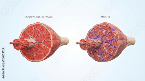 3D Cross-Section of Healthy Skeletal Muscle vs Myositis Inflammation
