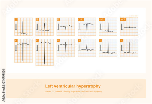Foto Left ventricular hypertrophy is often accompanied by ST-T changes; these are cha