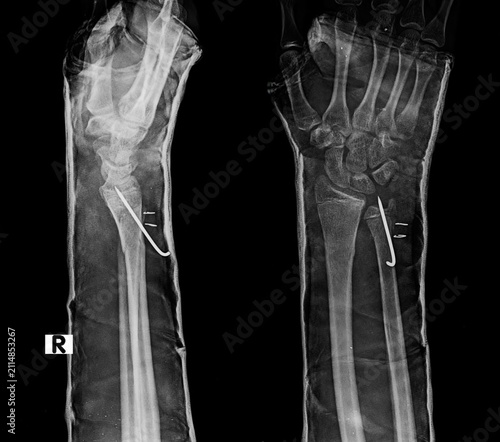 Konstfotografi AP and lateral wrist radiograph demonstrating distal radius Kirschner wire fixat