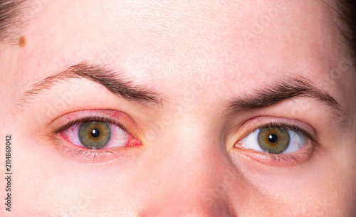 Cuadro en lienzo Red eye due to viral or bacterial infection