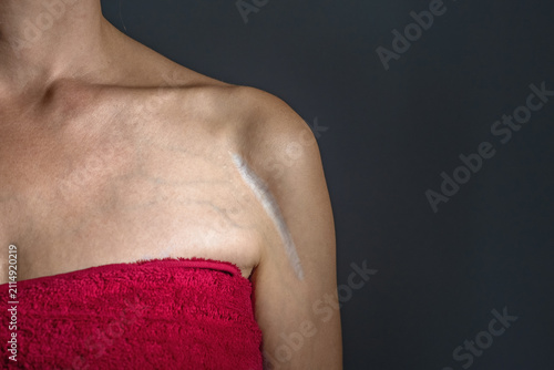 Quadro su tela Healed surgical scar from fractured forearm of woman with bare shoulders in red towel on dark, isolated