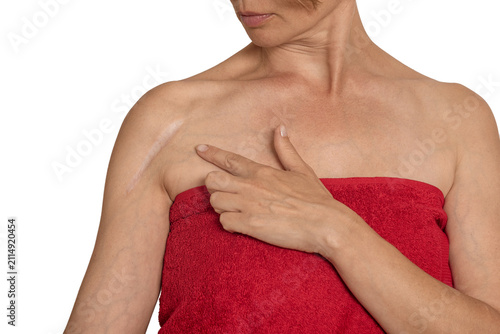 Konstfotografi Woman with bare shoulders in red towel points to scar on arm after fracture surgery