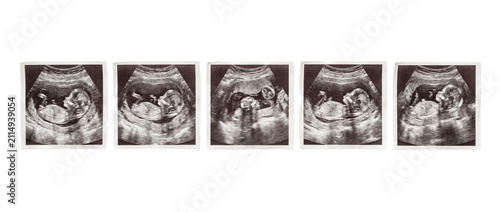 Baby ultrasound sonogram scan sequence showing fetus development stages during pregnancy medical examination, representing human life growth, expecting parents, obstetrics, and gynecology healthcare.