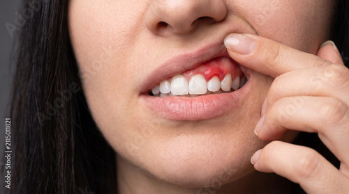 Close-up of woman with inflamed and bleeding gum showing gum disease symptoms
