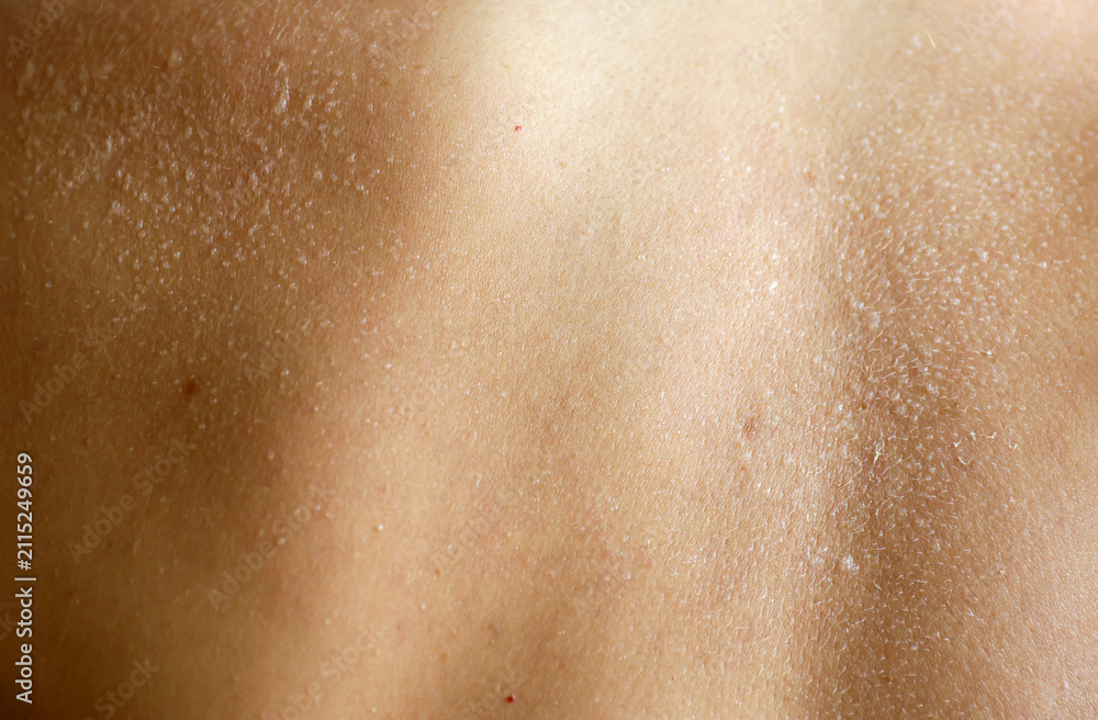 Fototapeta premium A close-up view of dry, peeling skin on a person woman back, illustrating dermatology, skin dehydration, peeling after sunburn, and health care