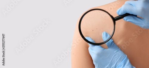 Dermatologist examining mol...