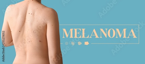 Human back with moles and m...