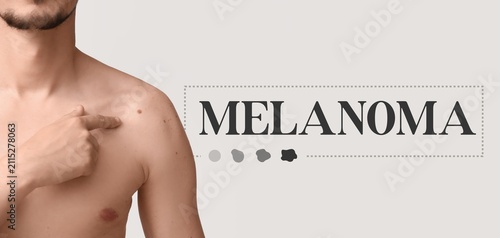 Man pointing at a mole on h...