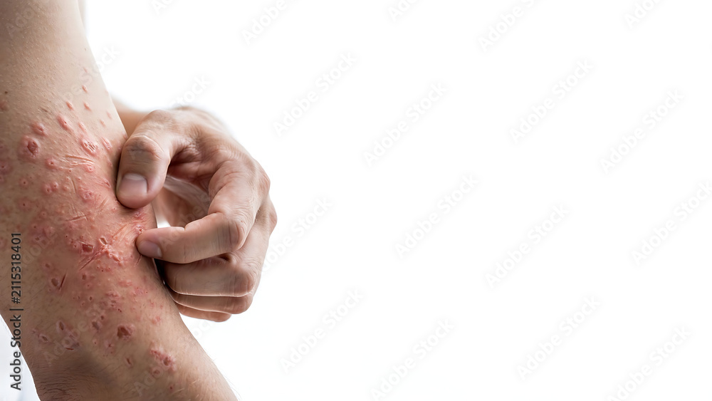 Fototapeta premium Close-up view of a person scratching an itchy skin rash on their arm as a symptom of a dermatological condition or an allergic reaction