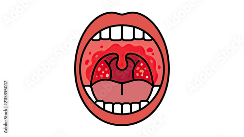 Foto Illustration of inflamed tonsils and throat